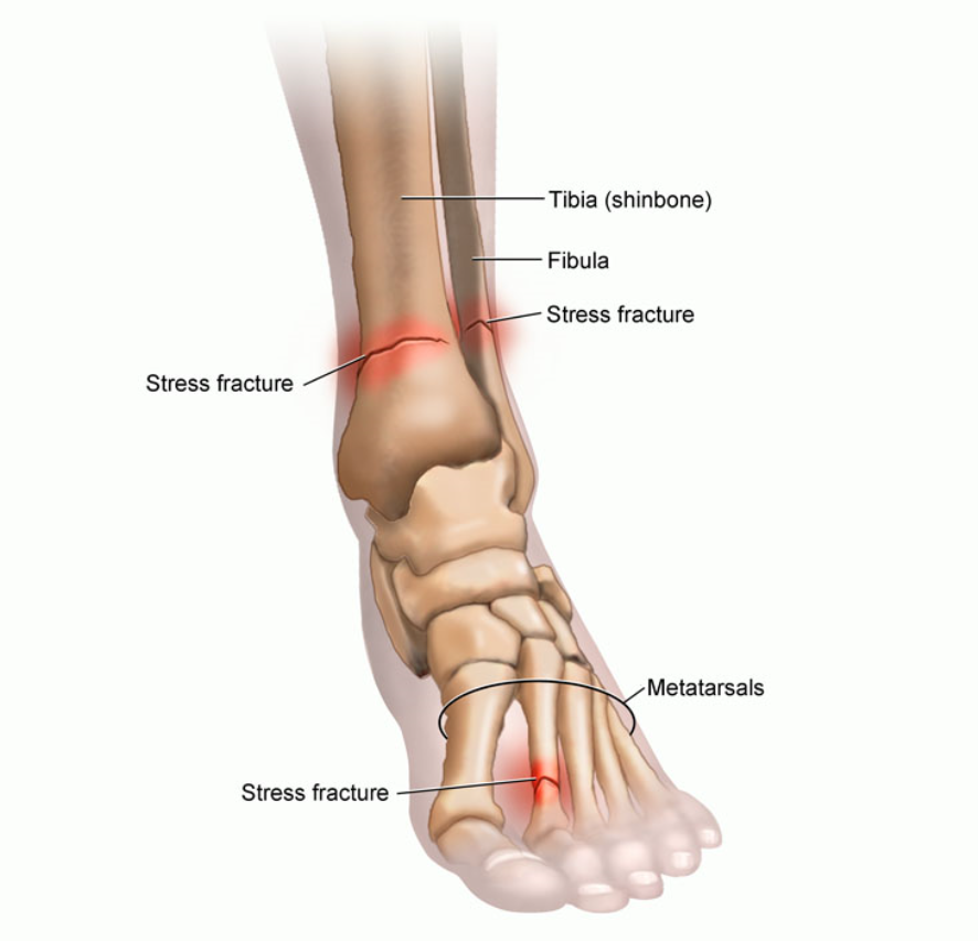 Common Stress Fractures Of The Foot – Howard J. Luks, MD